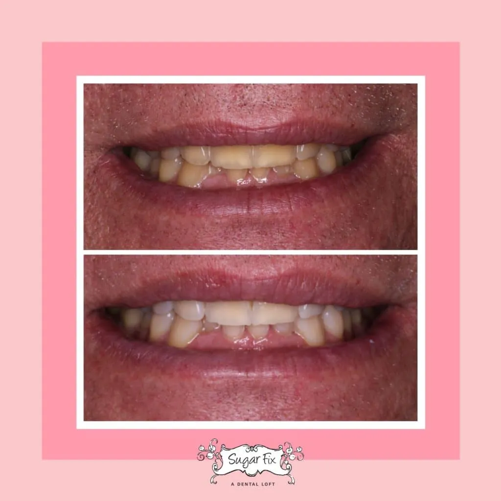 28415 at home teeth whitening kit