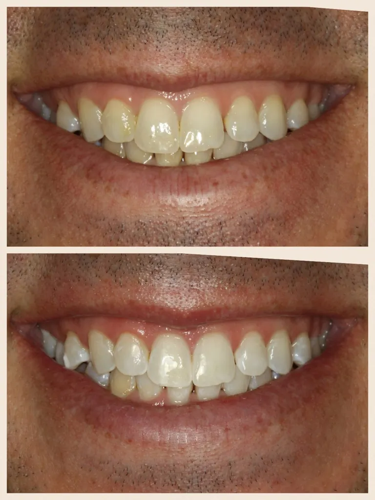 28415 teeth whitening science