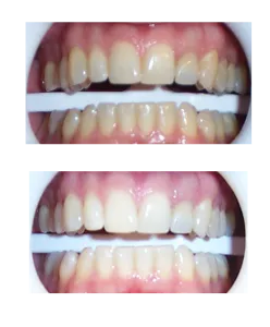 28420 teeth whitening maintenance