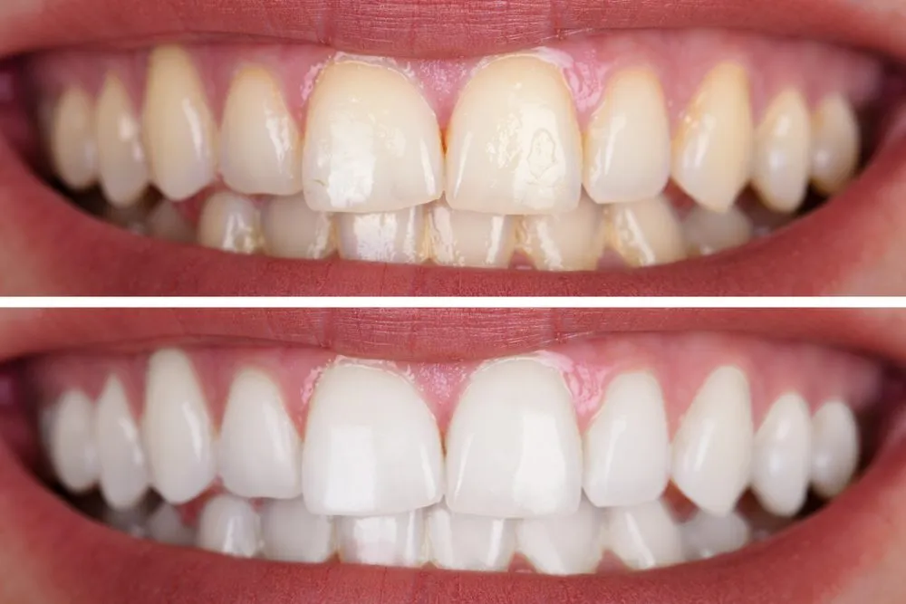 28429 insurance teeth whitening