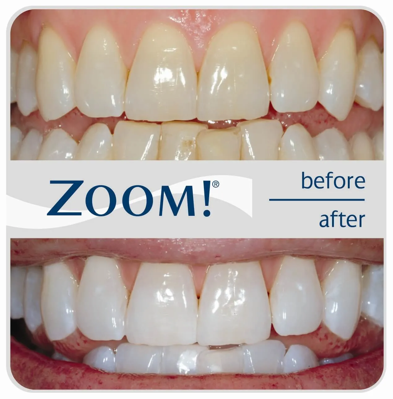 28429 professional teeth whitening