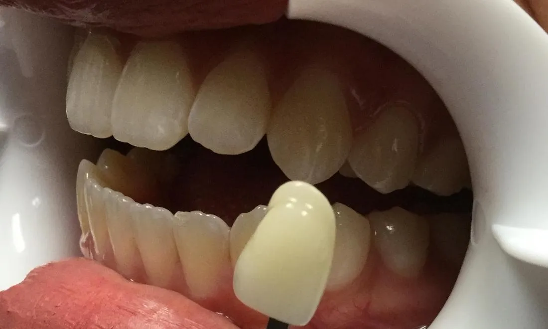 28430 in office tooth whitening