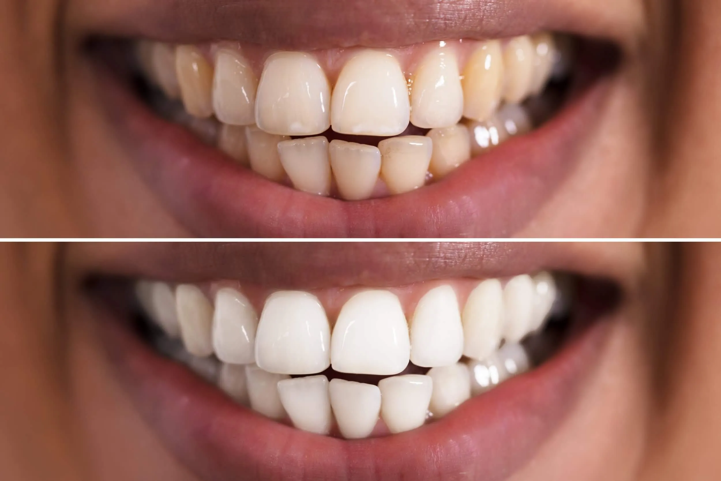 28437 teeth whitening cost birmingham