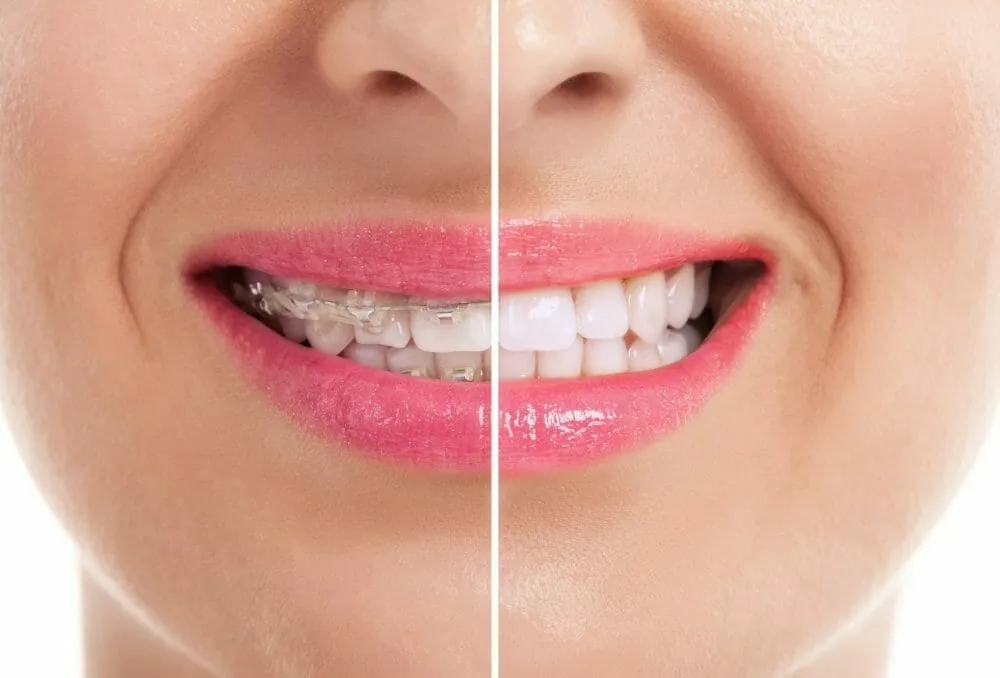 28438 professional teeth whitening 4