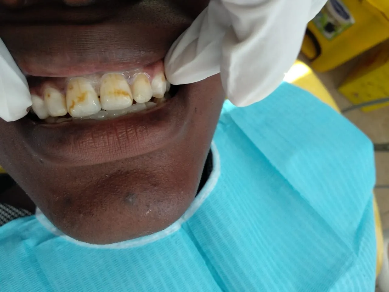 28444 teeth whitening nairobi diet