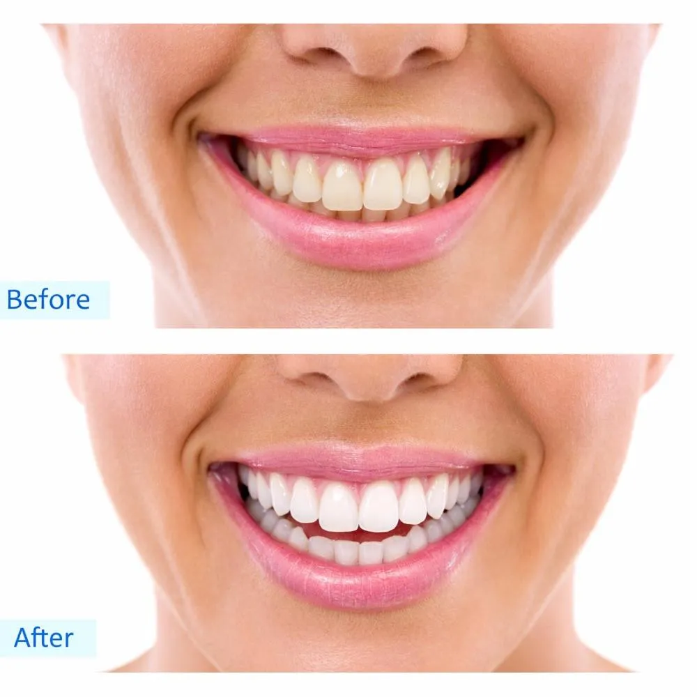 28444 teeth whitening nairobi oral hygiene