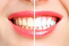 28444 teeth whitening nairobi products