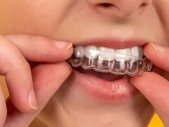 28444 teeth whitening nairobi take home kit