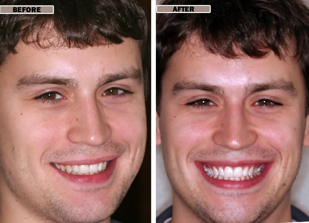 28447 smile whitening before after