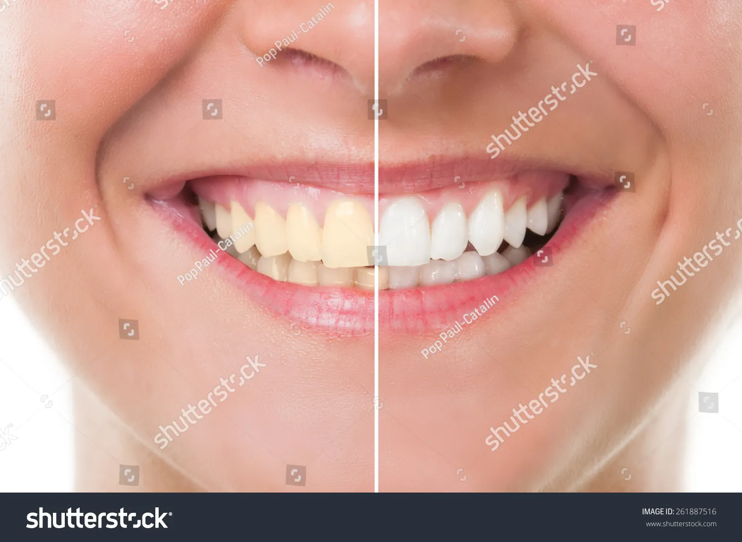28447 smile whitening result1