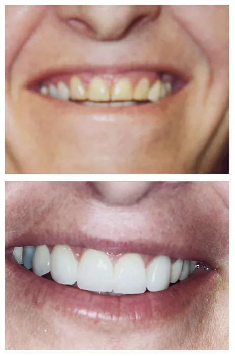 28449 teeth whitening maintenance