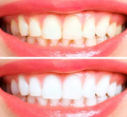28450 denton teeth whitening smile