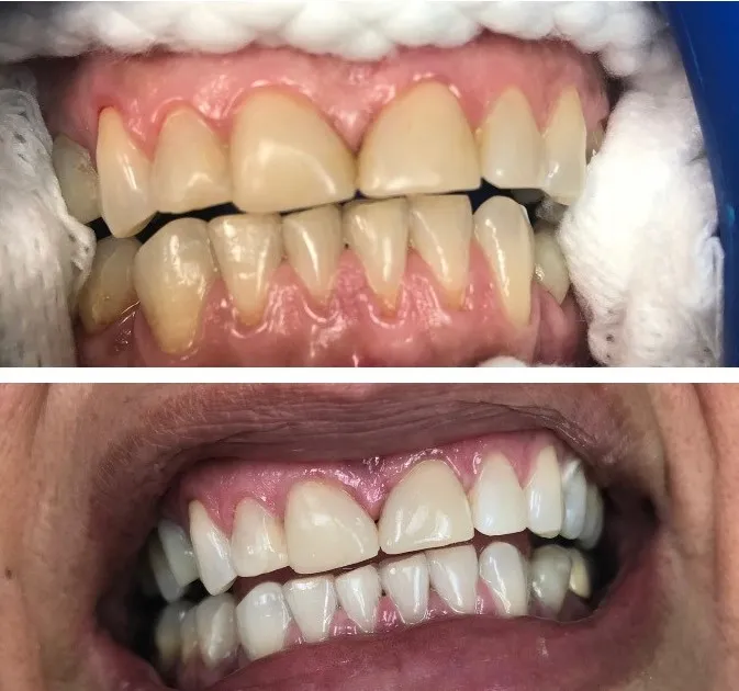 28450 teeth whitening diet