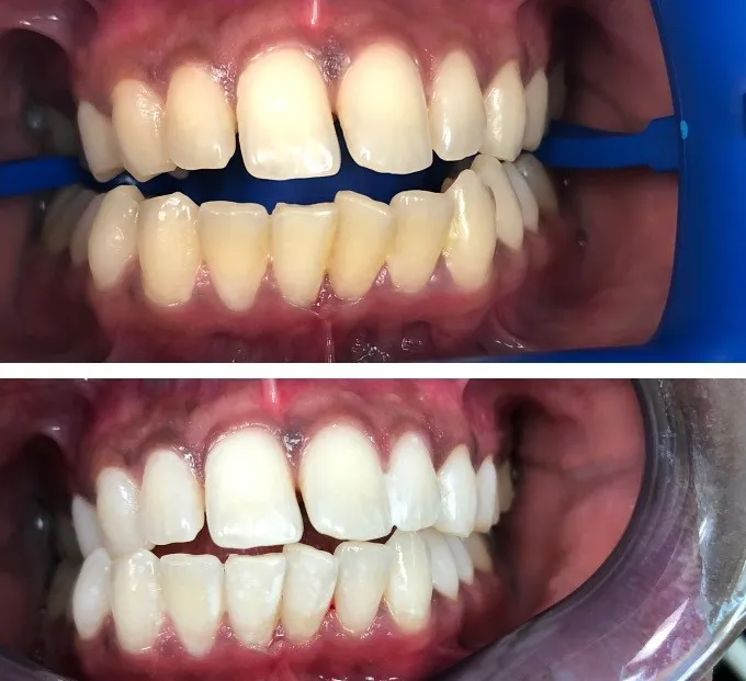 28450 teeth whitening maintenance