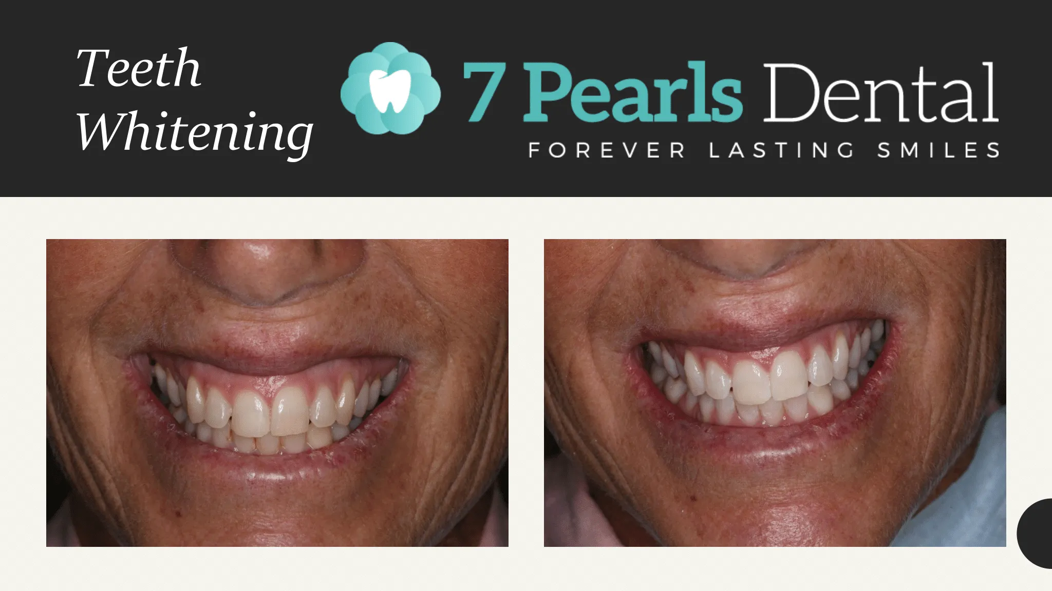 28452 types of teeth whitening