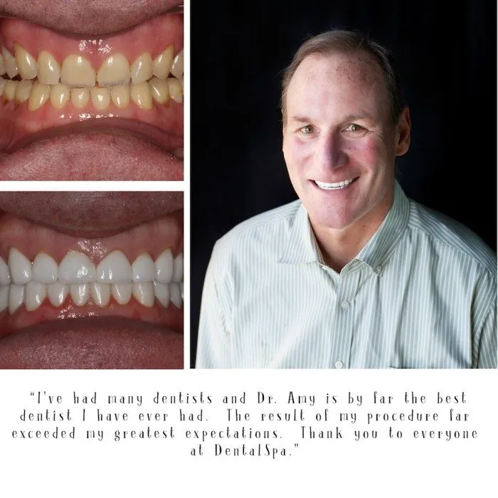 28457 professional teeth whitening indianapolis