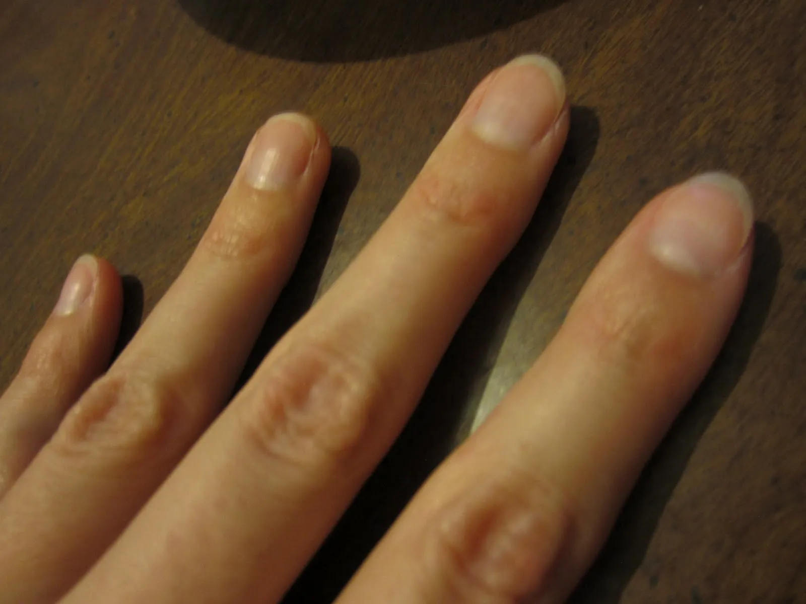 28465 nail discoloration causes
