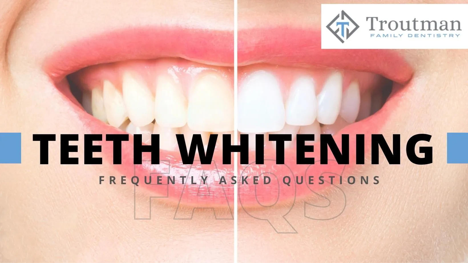 /img/28470-teeth-whitening-savannah-ga-image8.webp