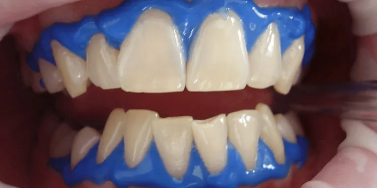 28475 teeth whitening sensitivity 5