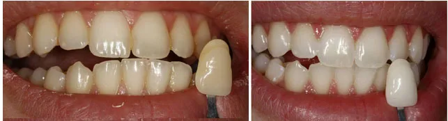 28483 at home teeth whitening kits