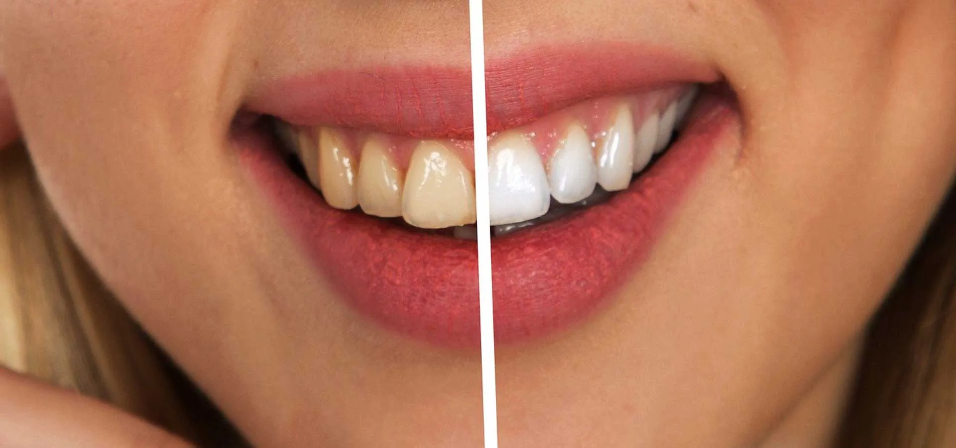 28488 tooth whitening sensitivity causes