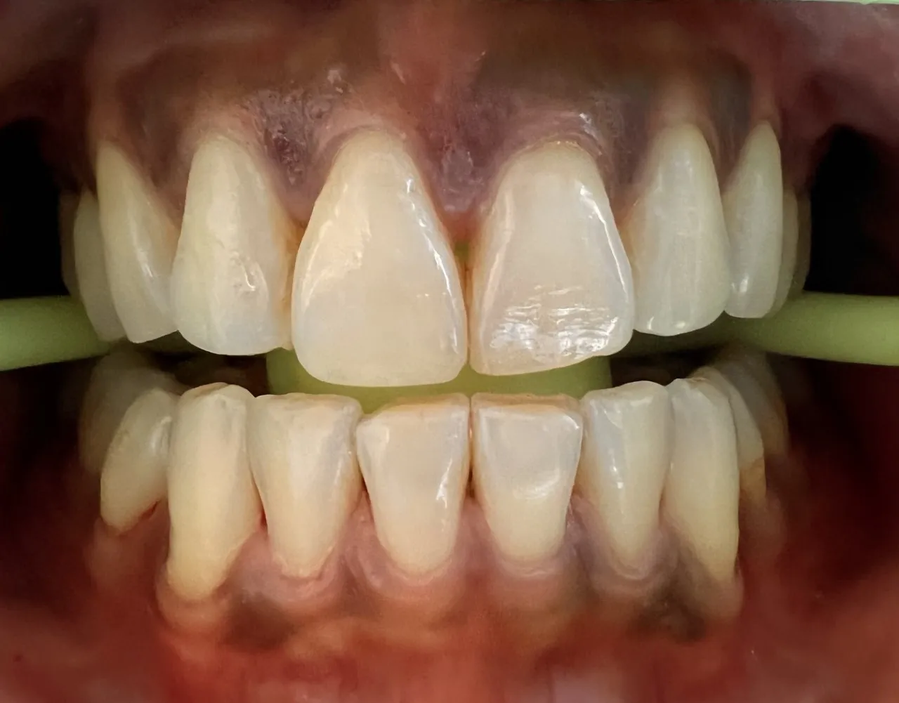 28491 professional teeth whitening