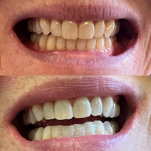 28491 teeth whitening aftercare