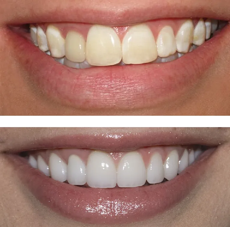 28491 teeth whitening basics