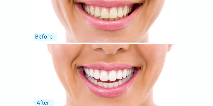 28491 teeth whitening sensitivity