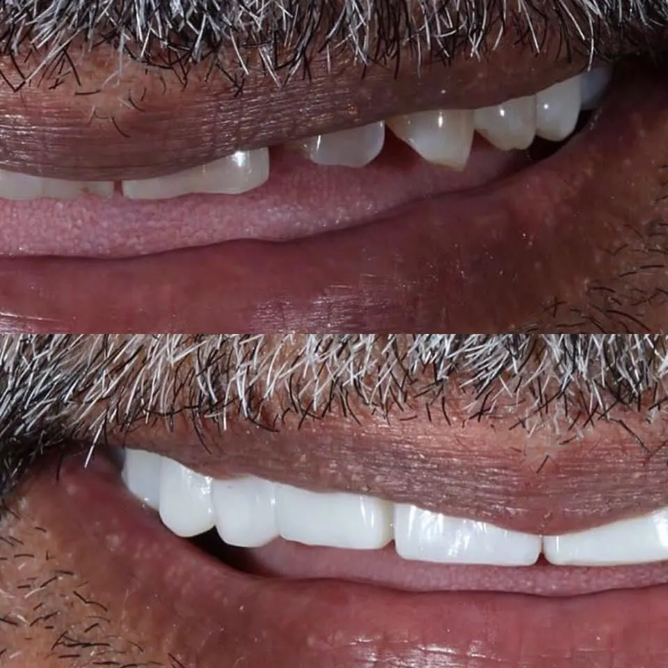 28491 tooth discoloration