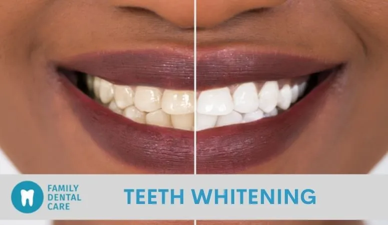 28497 in office teeth whitening