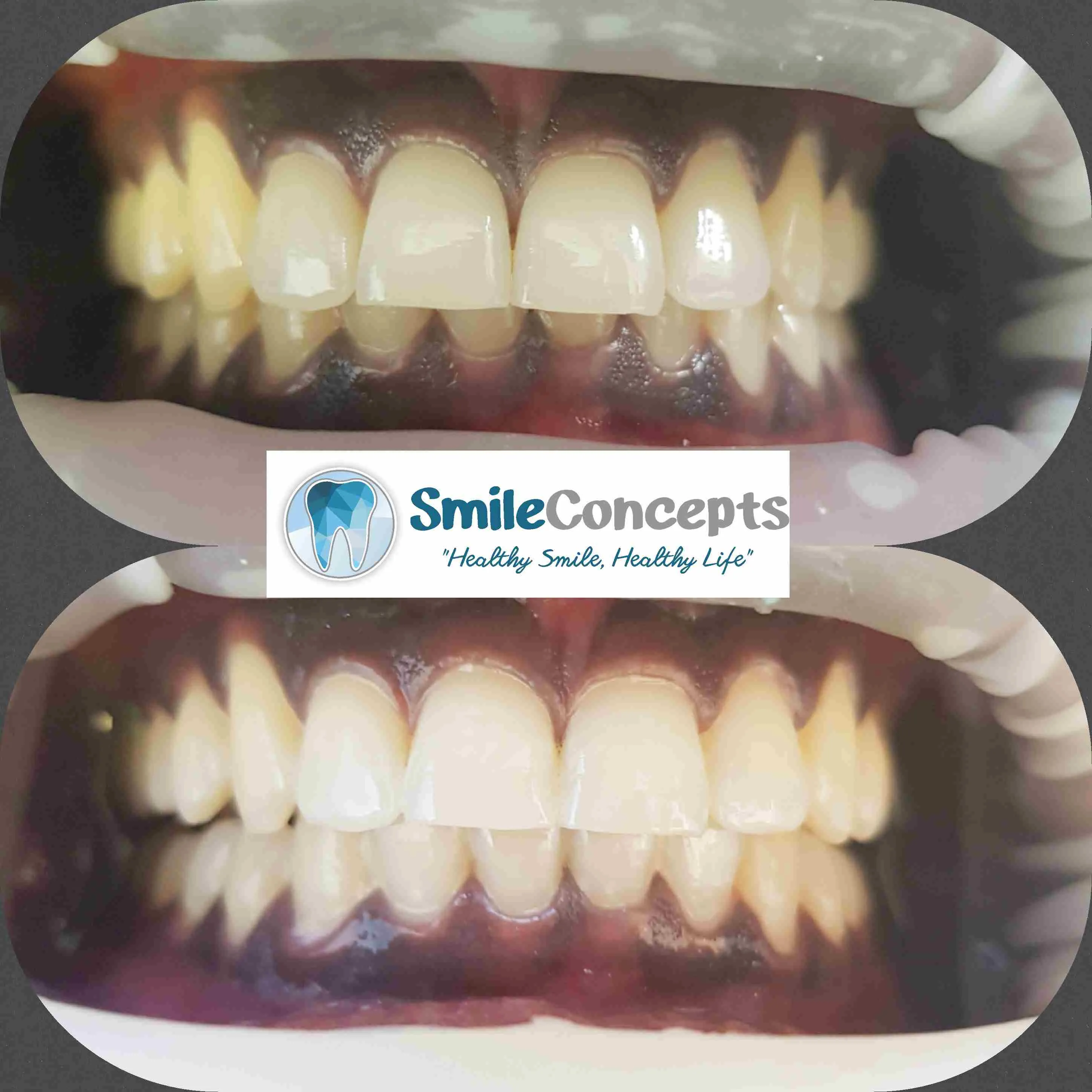 28497 teeth whitening deals