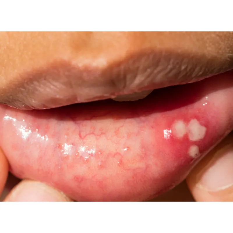 28500 canker sore treatment