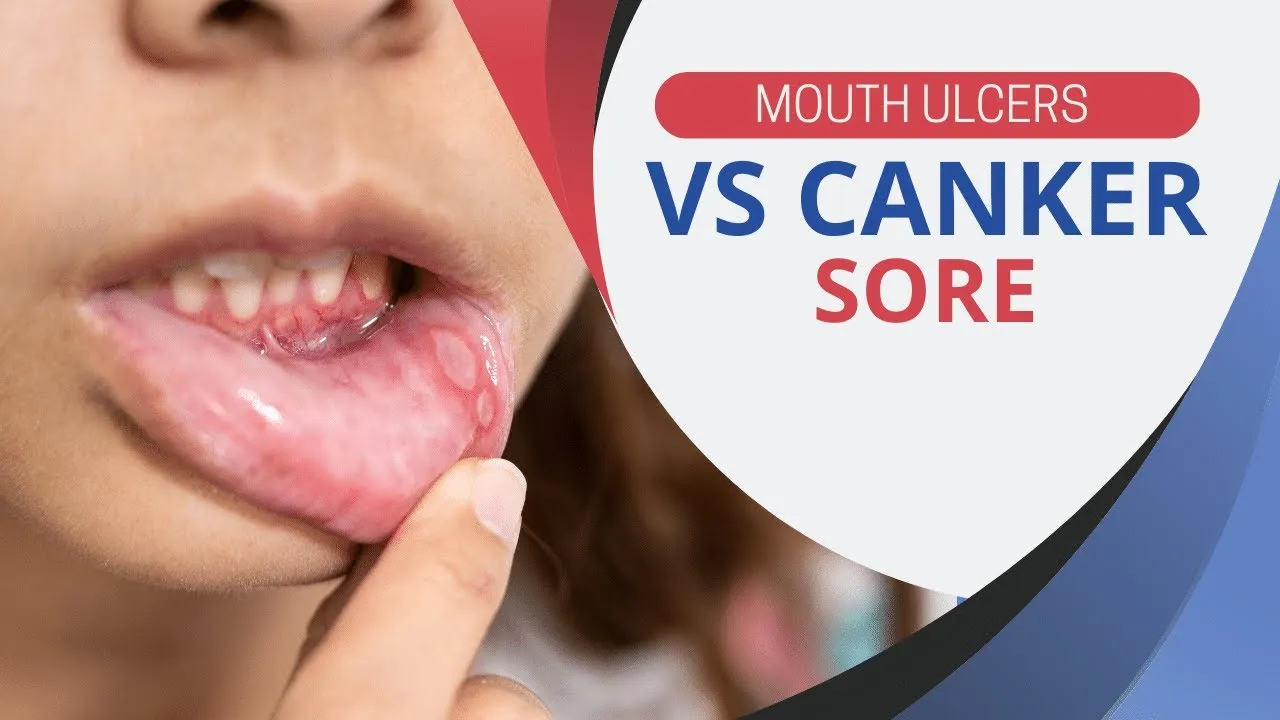 28500 canker sores symptoms