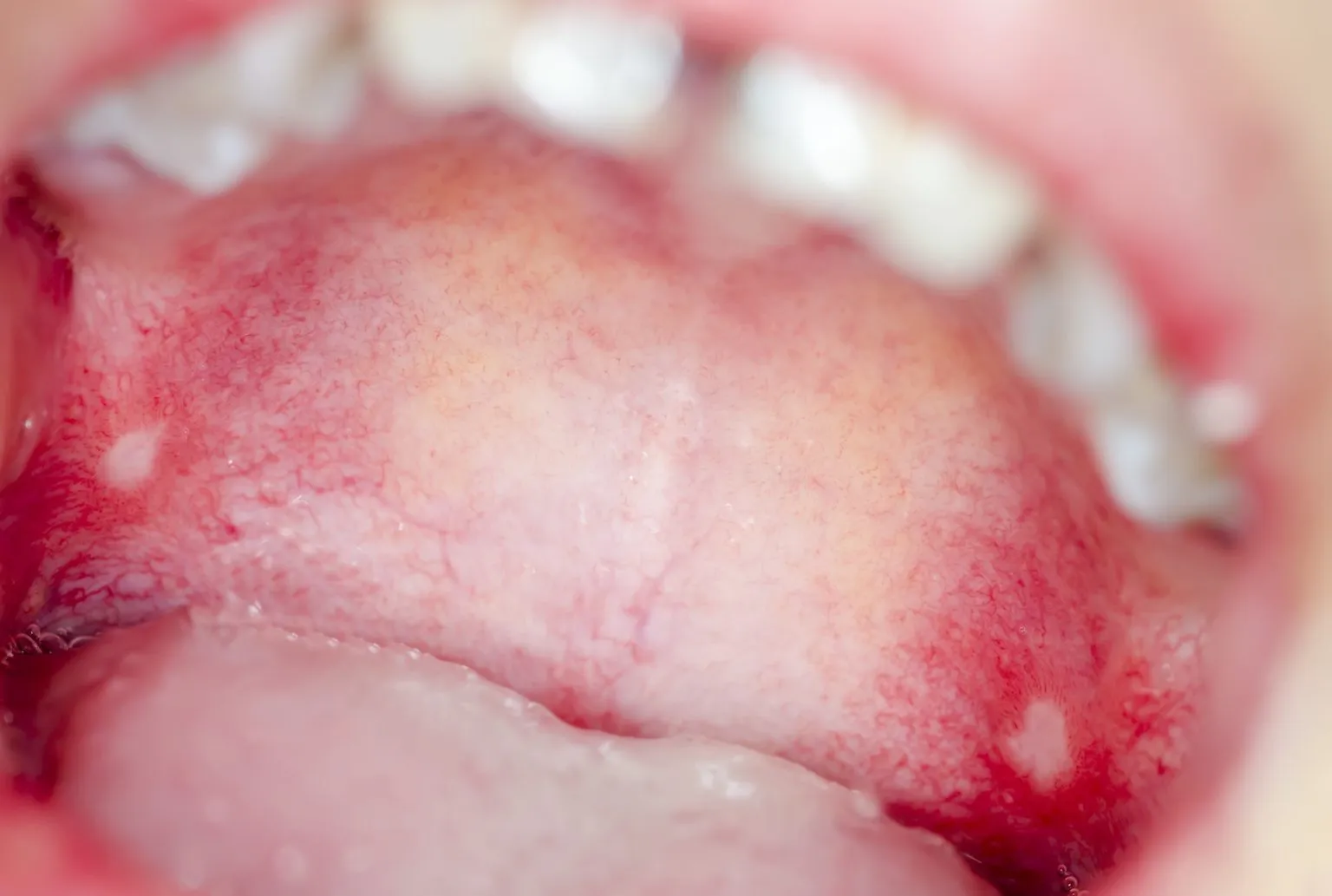 28500 preventing canker sores
