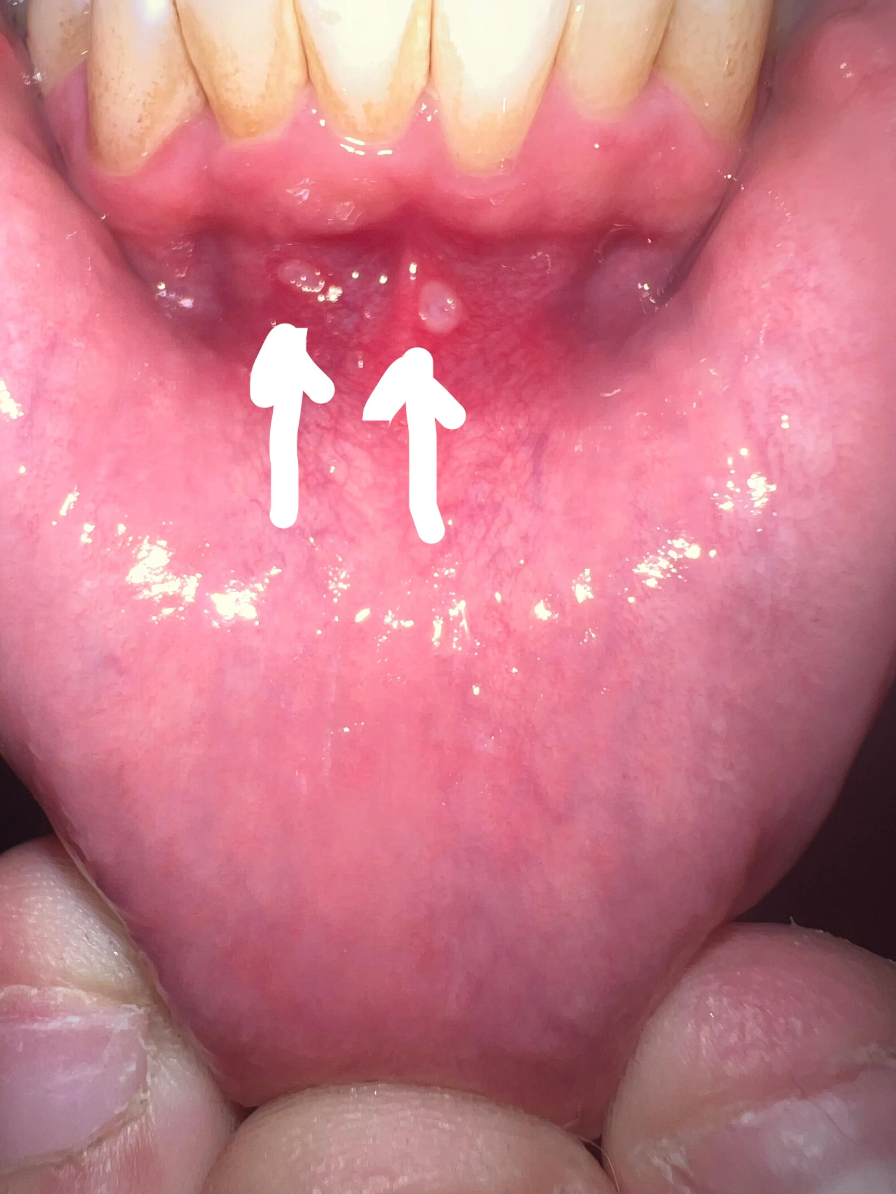 28500 teeth whitening side effects