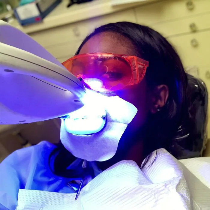 28505 laser teeth whitening process