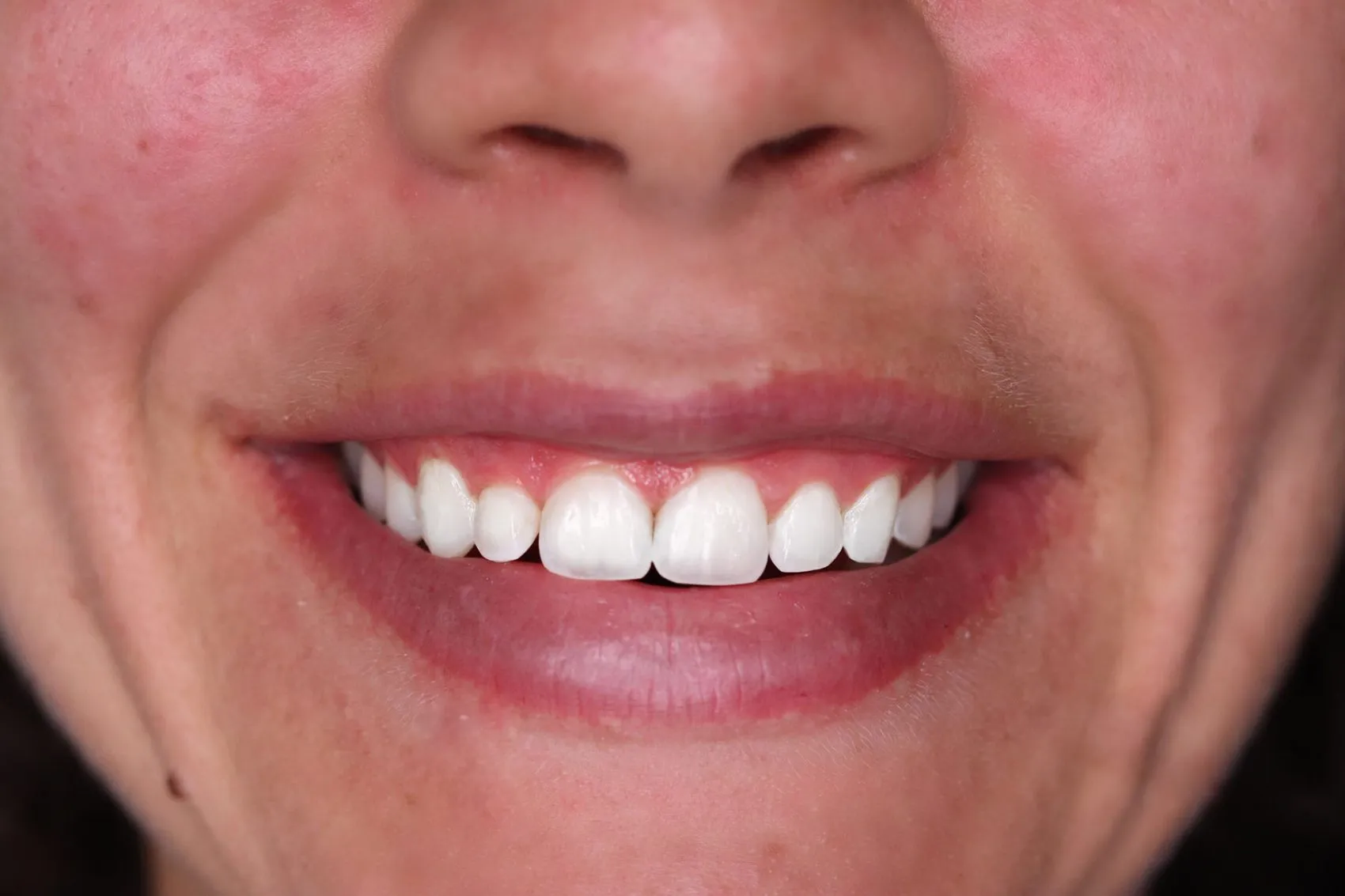 /img/28509-post-whitening-care.webp