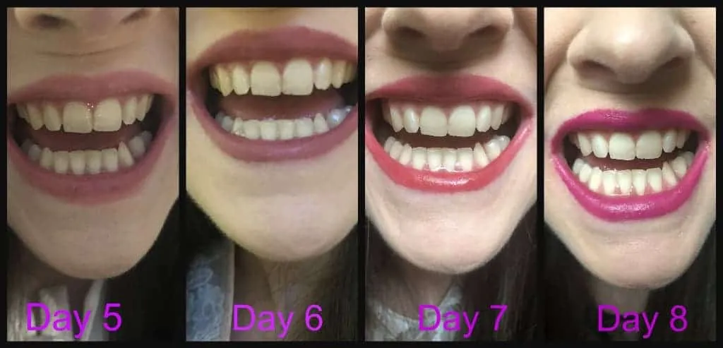 28509 professional teeth whitening