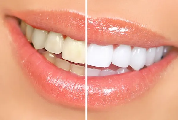 28509 teeth whitening methods