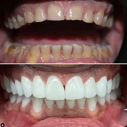 28516 teeth whitening procedure