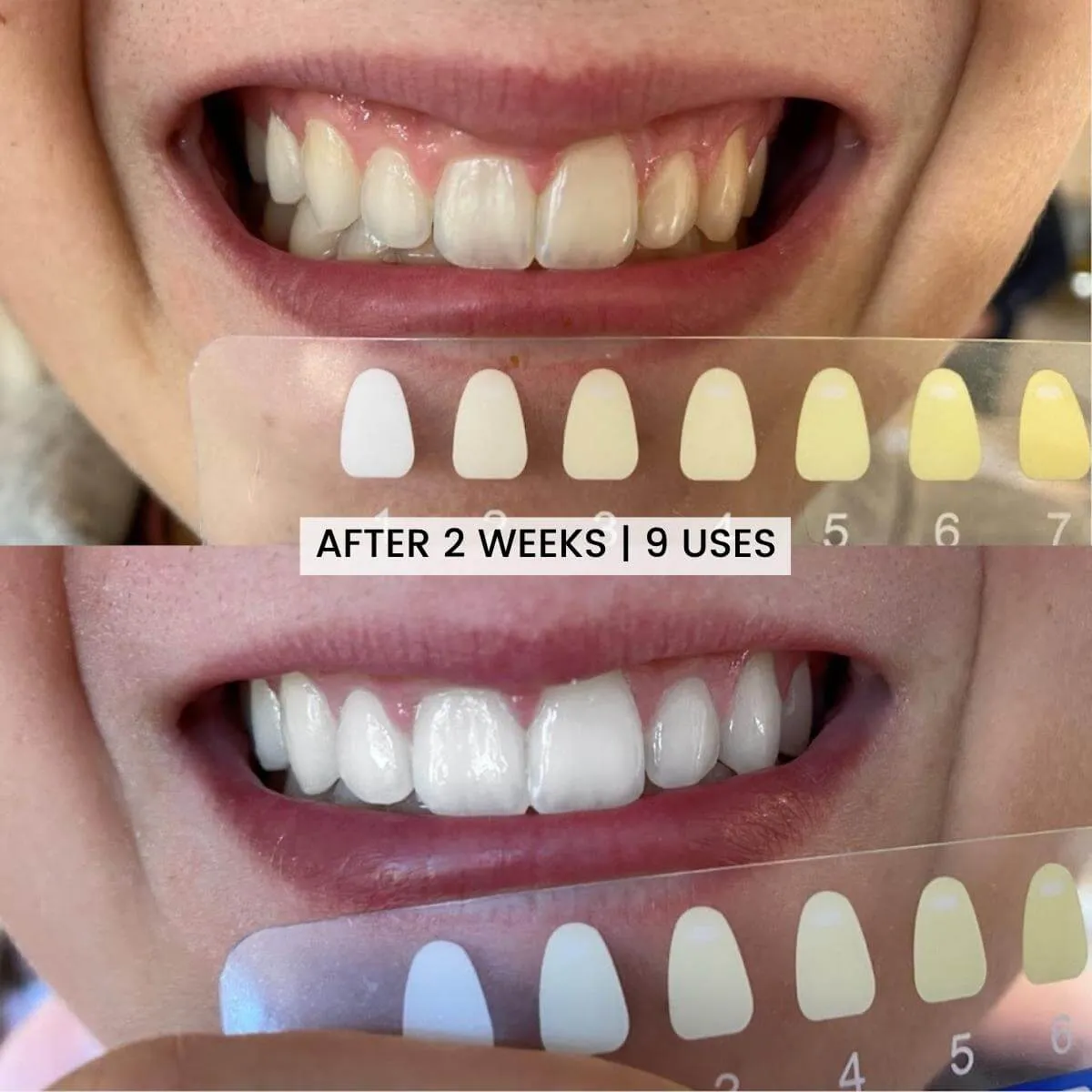 28527 diamond white teeth whitening before after