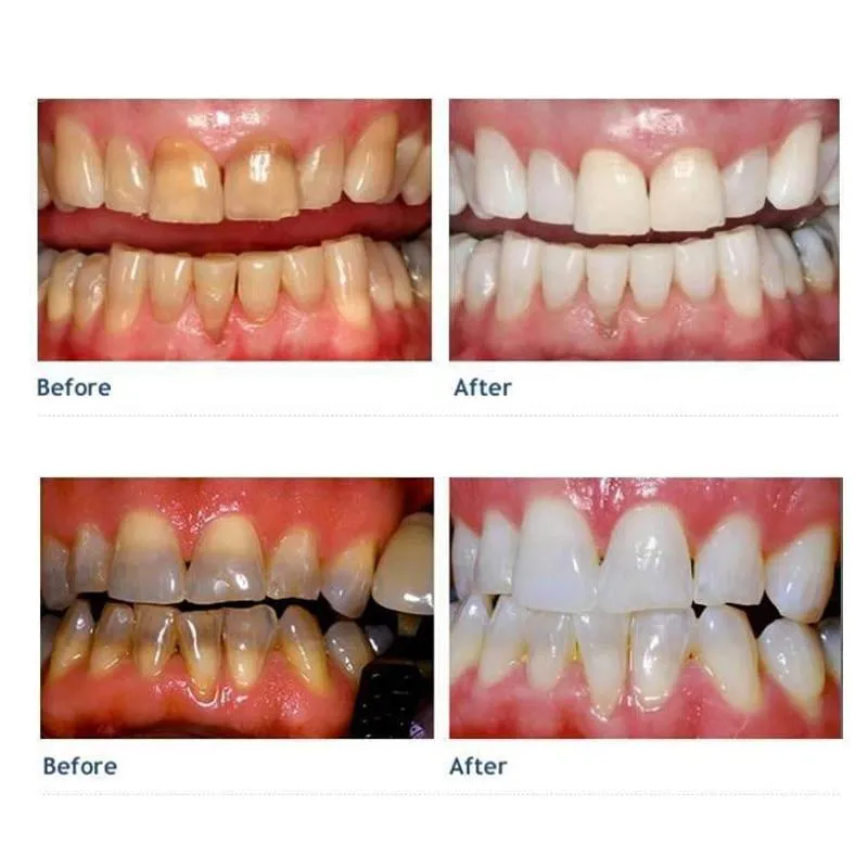 28531 nano teeth whitening kit image3