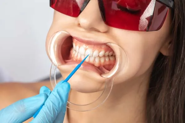28536 at home teeth whitening