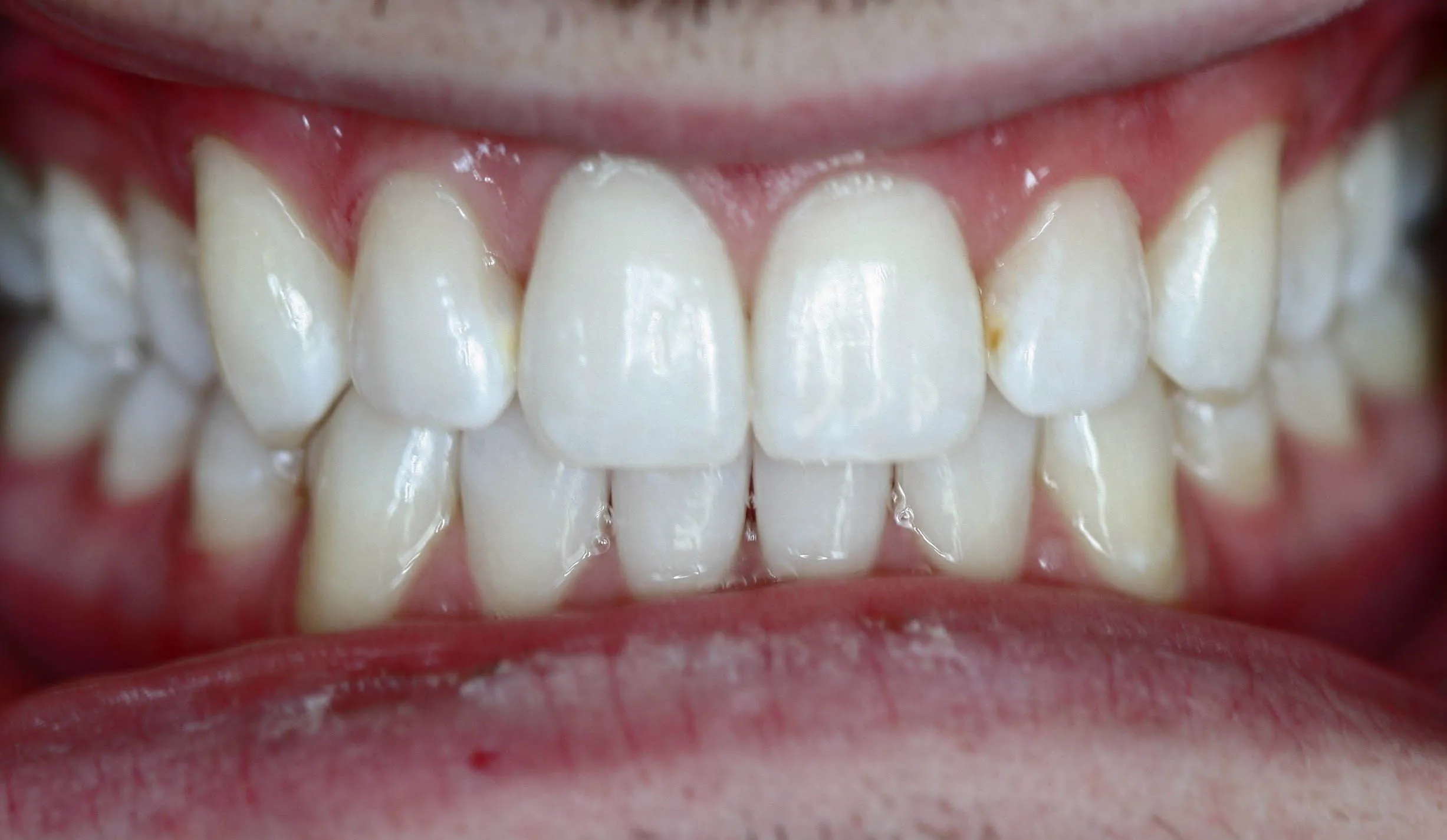 28536 teeth whitening maintenance