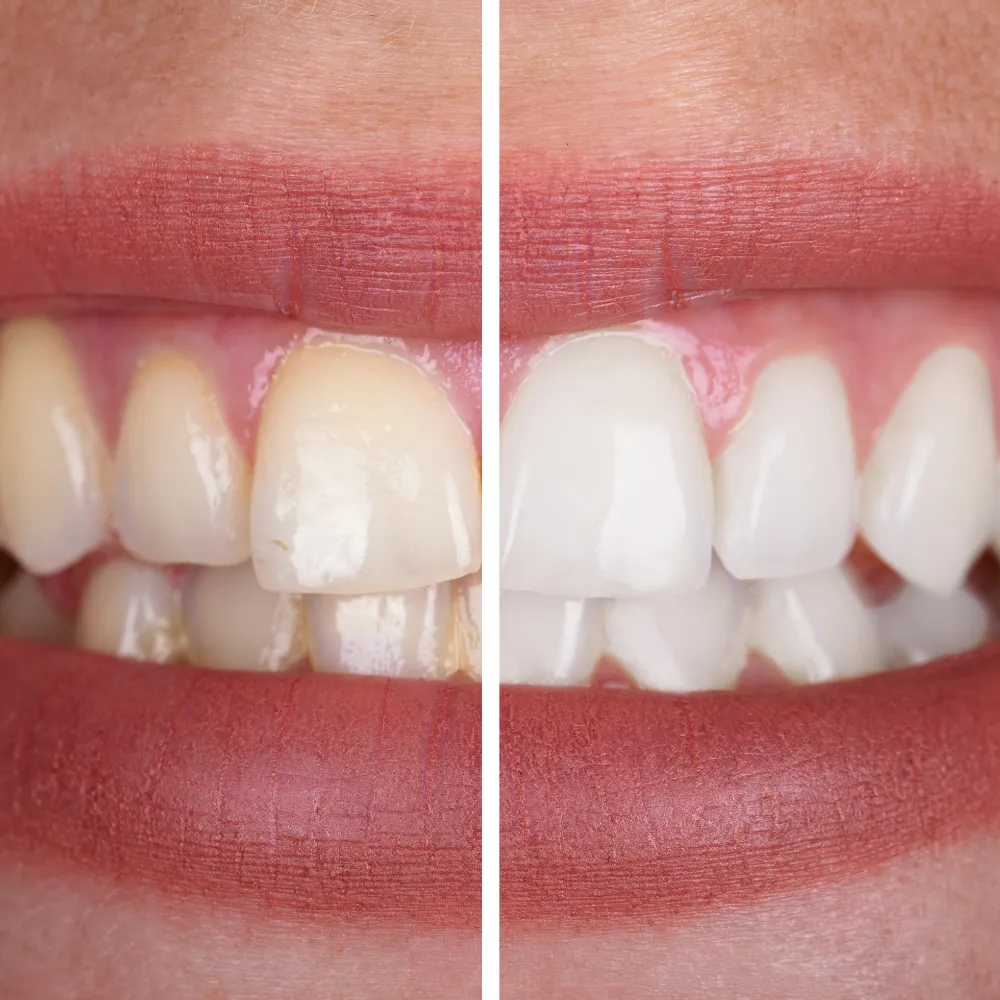 28544 teeth whitening results