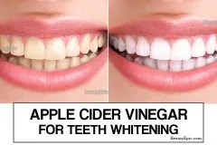 28545 professional teeth whitening