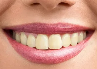 28547 teeth whitening aldridge at home kit