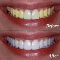 28547 teeth whitening aldridge brushing flossing