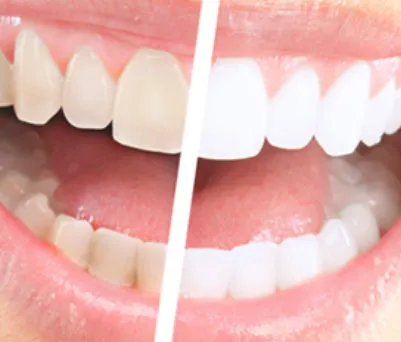 /img/28547-teeth-whitening-aldridge-smile.webp